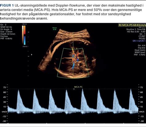 rhd positiv gravid|Rhesustypebestemmelse